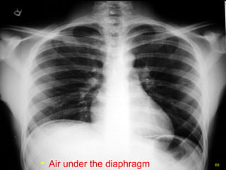 Air under the diaphragm 