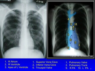 R Atrium R Ventricle 3.  Apex of L Ventricle Superior Vena Cava Inferior Vena Cava 6.  Tricuspid Valve Pulmonary Valve Pulmonary Trunk 9.  R PA  10.  L  PA 