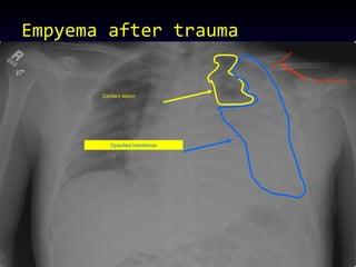 Empyema after trauma Clavicle fracture Cavitary lesion Opacified hemithorax 