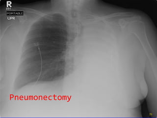 Pneumonectomy 