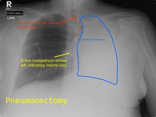 Pneumonectomy Entire mediastinum shifted left, indicating  volume loss Opacified left hemithorax Trachea shifted left, indicating  volume   loss 