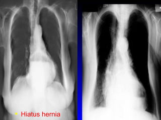 Hiatus hernia 