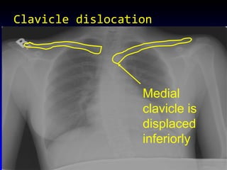 Clavicle dislocation Medial clavicle is displaced inferiorly 
