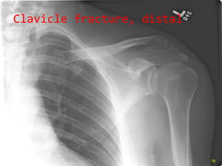 Clavicle fracture, distal 