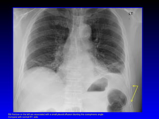 LT. Rib fracture on the left are associated with a small pleural effusion blunting the costophrenic angle. Compare with normal RT. side. 