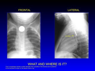 FRONTAL LATERAL WHAT AND WHERE IS IT? Air stripe Coin in esophagus shows a wider diameter than possible in the trachea and is posterior to the tracheal air stripe on the lateral chest x-ray. 