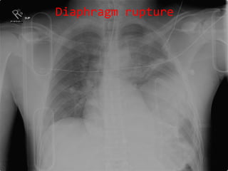 Diaphragm rupture 