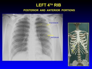 LEFT 4 TH  RIB   POSTERIOR  AND  ANTERIOR  PORTIONS POSTERIOR ANTERIOR 4 A P 