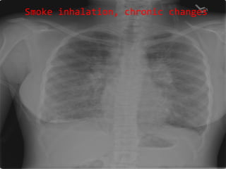 Smoke inhalation, chronic changes 