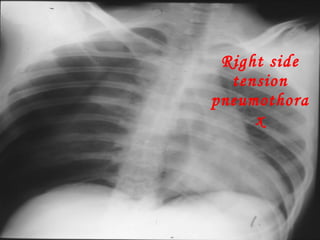 Right side tension pneumothorax 