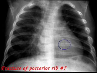 Fracture of posterior rib #7 