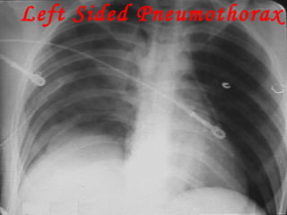 Left Sided Pneumothorax 