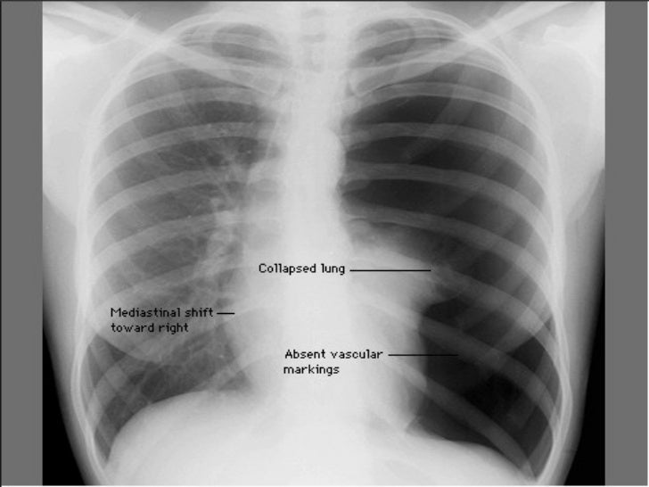 Chest Xray diagram pneumonia x ray 