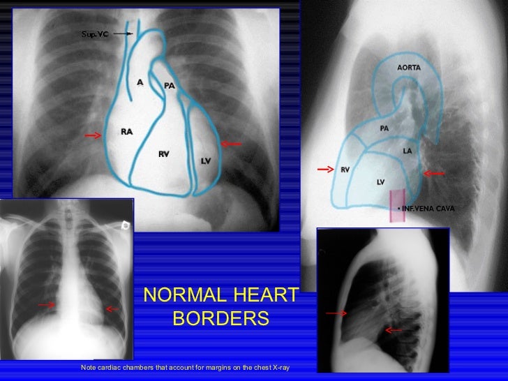 Lovely 77 Cardiac Border Chest X Ray