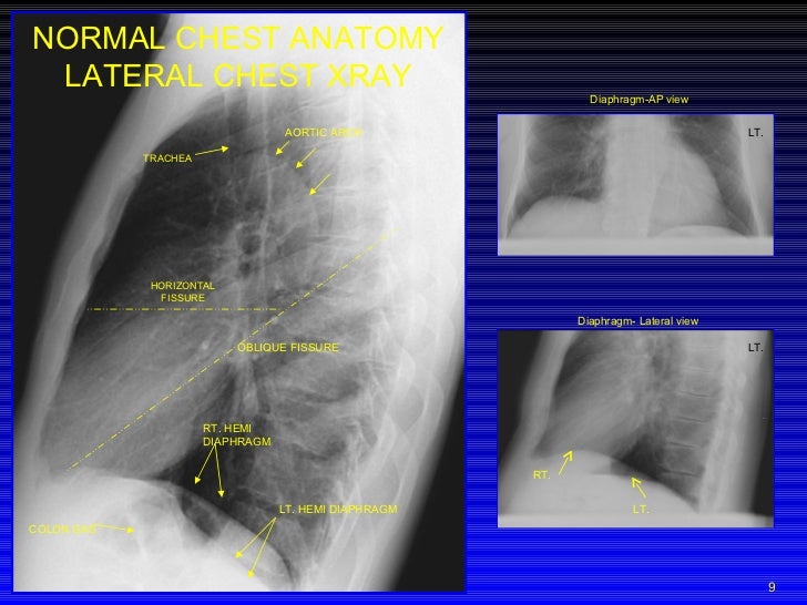 Chest Xray