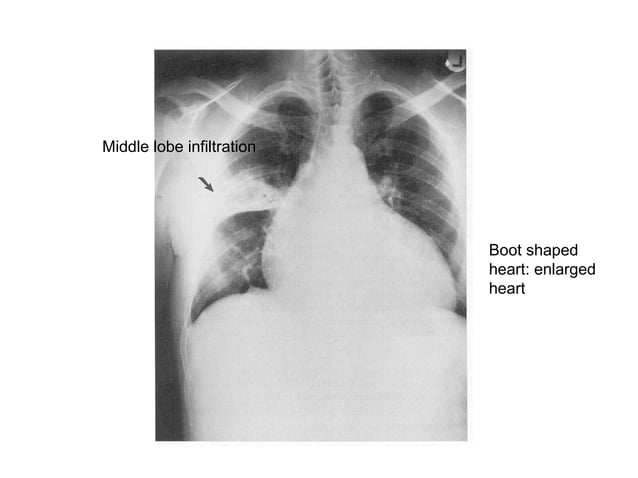 Chest X Ray Interpretation | PPT | Lung and Respiratory Health ...