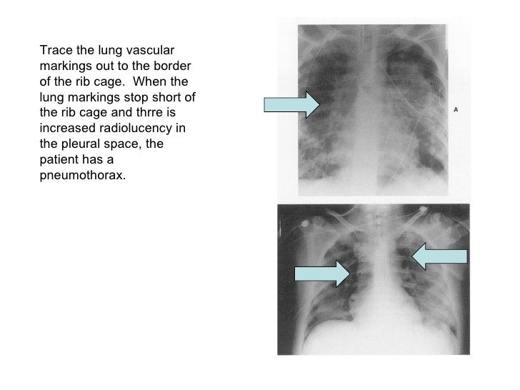 Chest X Ray Interpretation