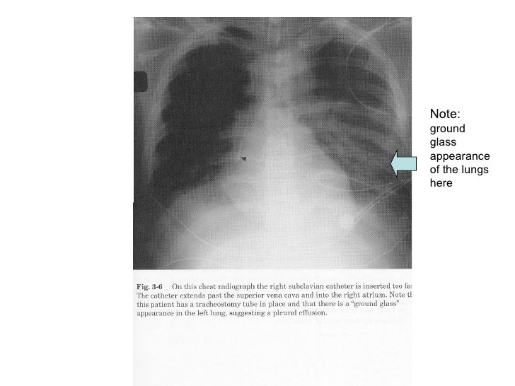 Chest X Ray Interpretation