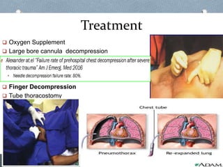 Treatment
 Oxygen Supplement
 Large bore cannula decompression
 Finger Decompression
 Tube thoracostomy
 