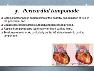 5. Pericardial tamponade
 Cardiac tamponade is compression of the heart by accumulation of fluid in
the pericardial sac.
 Causes decreased cardiac output due to decreased preload.
 Results from penetrating (commonly) or blunt cardiac injury.
 Tension pneumothorax, particularly on the left side, can mimic cardiac
tamponade.
 