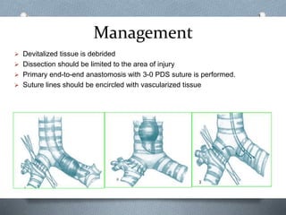 Management
 Devitalized tissue is debrided
 Dissection should be limited to the area of injury
 Primary end-to-end anastomosis with 3-0 PDS suture is performed.
 Suture lines should be encircled with vascularized tissue
 