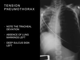 T E N S I O N
P N E U M O T H O R A X
• NOTE THE TRACHEAL
DEVIATION
• ABSENCE OF LUNG
MARKINGS LEFT
• DEEP SULCUS SIGN
LEFT
 