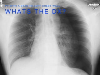 W H A T S T H E D X ?
P T W I T H A S T A B T O L E F T C H E S T W A L L
 