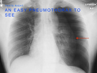 A N E A S Y P N E U M O T H O R A X T O
S E E
T H A T S R I G H T
 