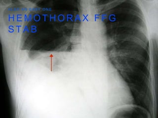 H E M O T H O R A X F F G
S T A B
A L S O A N E A S Y O N E
 