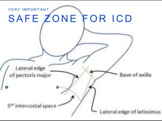 S A F E Z O N E F O R I C D
V E R Y I M P O R T A N T
 