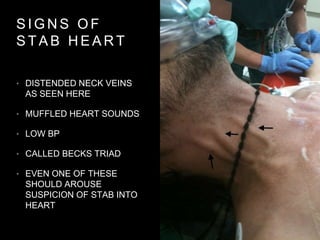 S I G N S O F
S T A B H E A R T
• DISTENDED NECK VEINS
AS SEEN HERE
• MUFFLED HEART SOUNDS
• LOW BP
• CALLED BECKS TRIAD
• EVEN ONE OF THESE
SHOULD AROUSE
SUSPICION OF STAB INTO
HEART
 