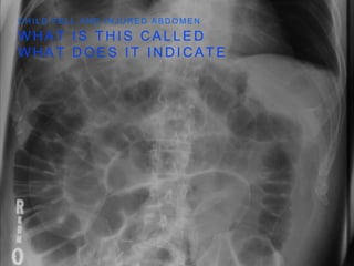 W H A T I S T H I S C A L L E D
W H A T D O E S I T I N D I C A T E
C H I L D F E L L A N D I N J U R E D A B D O M E N
 