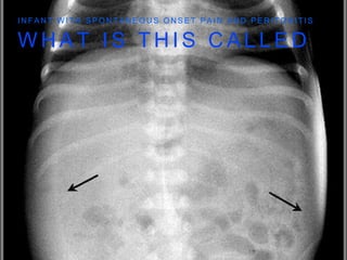W H A T I S T H I S C A L L E D
I N F A N T W I T H S P O N T A N E O U S O N S E T P A I N A N D P E R I T O N I T I S
 
