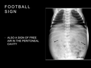 F O O T B A L L
S I G N
• ALSO A SIGN OF FREE
AIR IN THE PERITONEAL
CAVITY
 