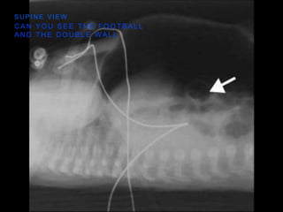 C A N Y O U S E E T H E F O O T B A L L
A N D T H E D O U B L E W A L L
S U P I N E V I E W
 