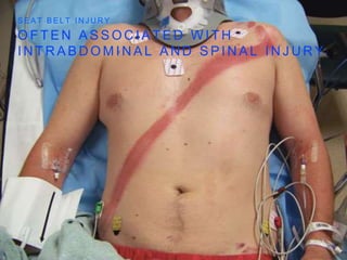 O F T E N A S S O C I A T E D W I T H
I N T R A B D O M I N A L A N D S P I N A L I N J U R Y
S E A T B E L T I N J U R Y
 