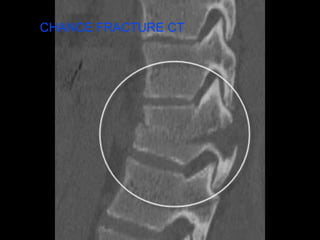 CHANCE FRACTURE CT
 
