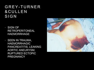 G R E Y - T U R N E R
& C U L L E N
S I G N
• SIGN OF
RETROPERITONEAL
HAEMORRHAGE
• SEEN IN TRAUMA,
HAEMORRHAGIC
PANCREATITIS, LEAKING
AORTIC ANEURYSM,
RUPTURED ECTOPIC
PREGNANCY
 