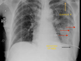 CLAVICLE #
ROTATION
OF RIBS
 