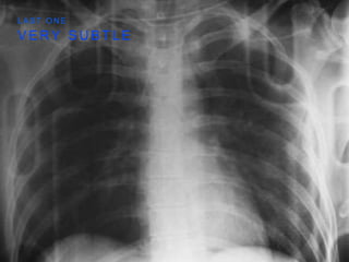 V E R Y S U B T L E
L A S T O N E
 