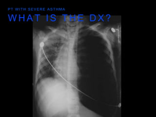 W H A T I S T H E D X ?
P T W I T H S E V E R E A S T H M A
 