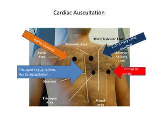 Cardiac Auscultation 
Tricuspid regugitatiion, 
Aorticregugitation , 
mitral or 
aorticvalve 
 