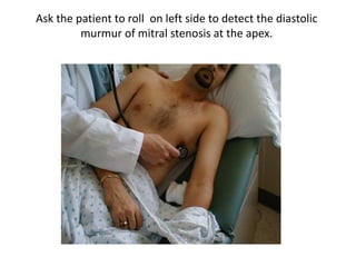 Ask the patient to roll on left side to detect the diastolic 
murmur of mitral stenosis at the apex. 
 