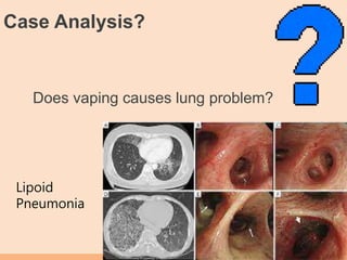 Case Analysis?
Does vaping causes lung problem?
Lipoid
Pneumonia
 