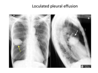Chest basics + usg dr patil 21818 | PPTX