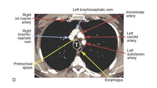 Brief summary on chest ct scans and differential diagnosis | PPTX