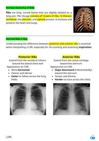 Particularly Ribs Comprehensive Clinical Guide to Chest X-Ray Interpretation and Anatomy ...