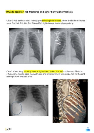 Comprehensive Clinical Guide to Chest X-Ray Interpretation and Anatomy ...
