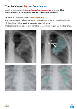 Air Bronchogram Rds Comprehensive Clinical Guide to Chest X-Ray Interpretation and Anatomy ...