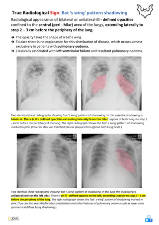 Comprehensive Clinical Guide to Chest X-Ray Interpretation and Anatomy ...